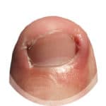 ingrown ingrown